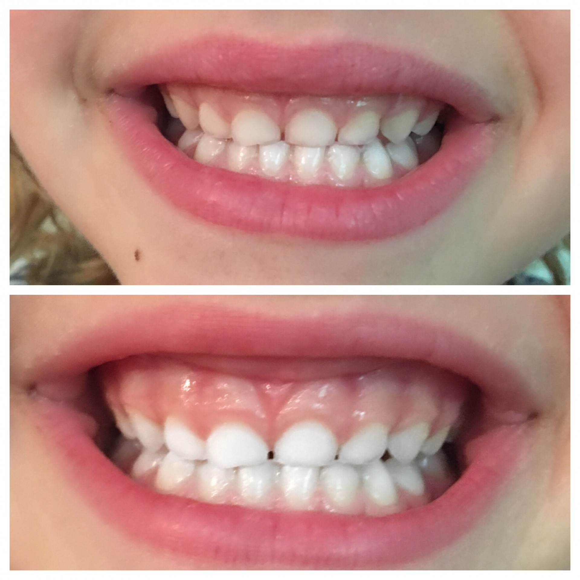 Can Kids Use Whitening Toothpaste?